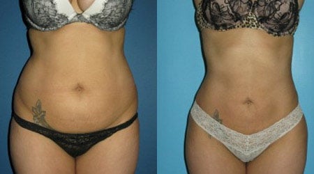 body tite - фото до и после