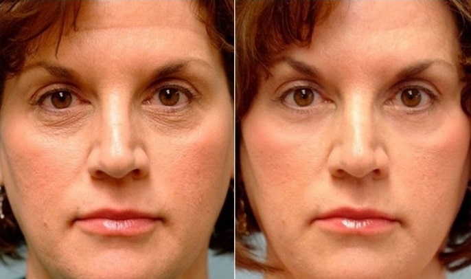 Фото до и после применения дермапена