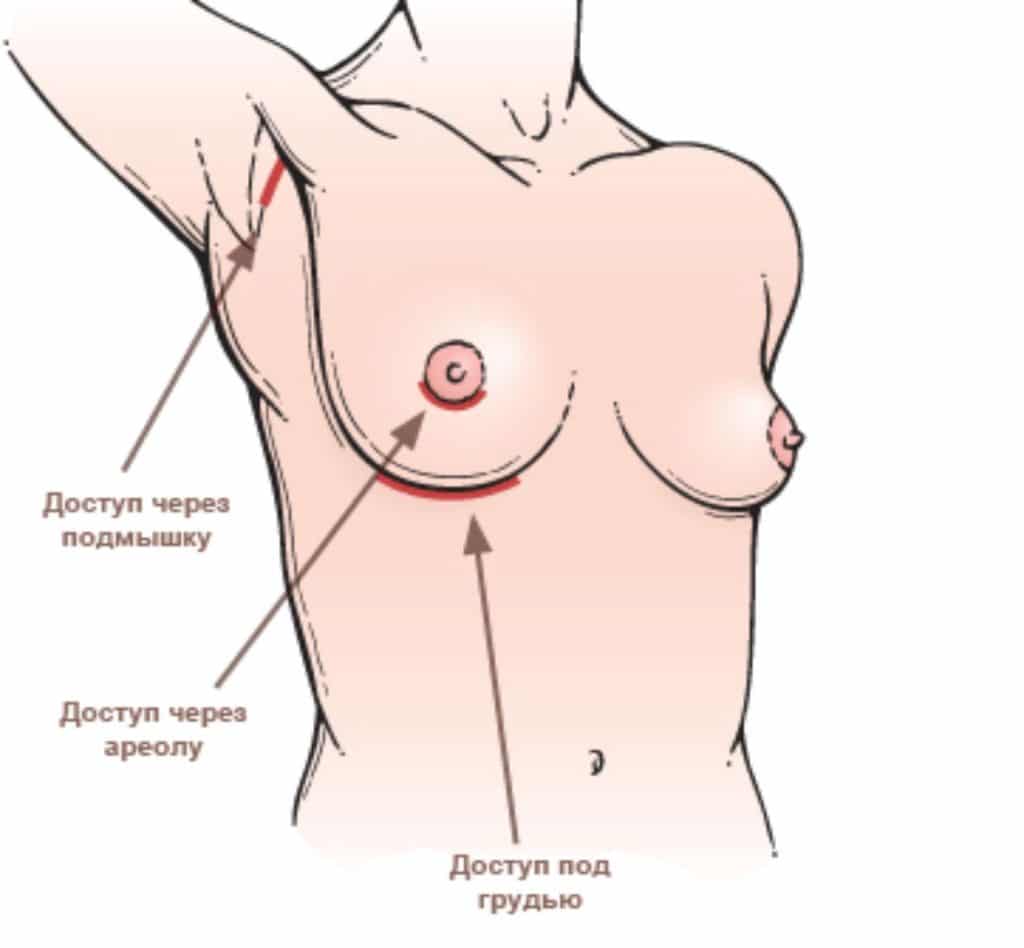 Техники проведения эндоскопической подтяжки груди