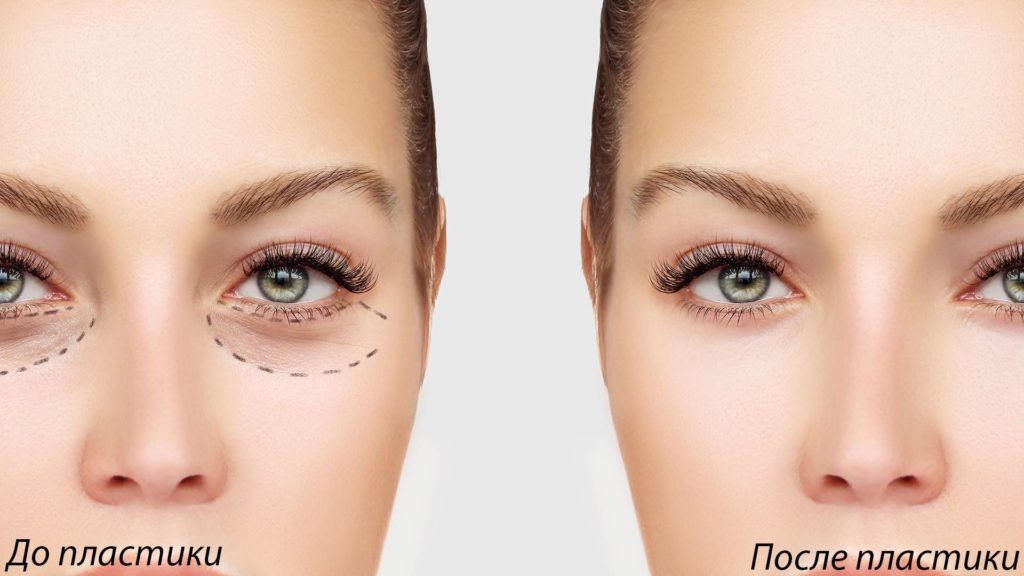 нижняя блефаропластика фото