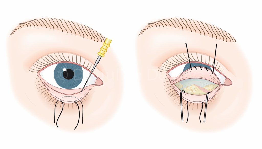 операция нижняя блефаропластика картинка